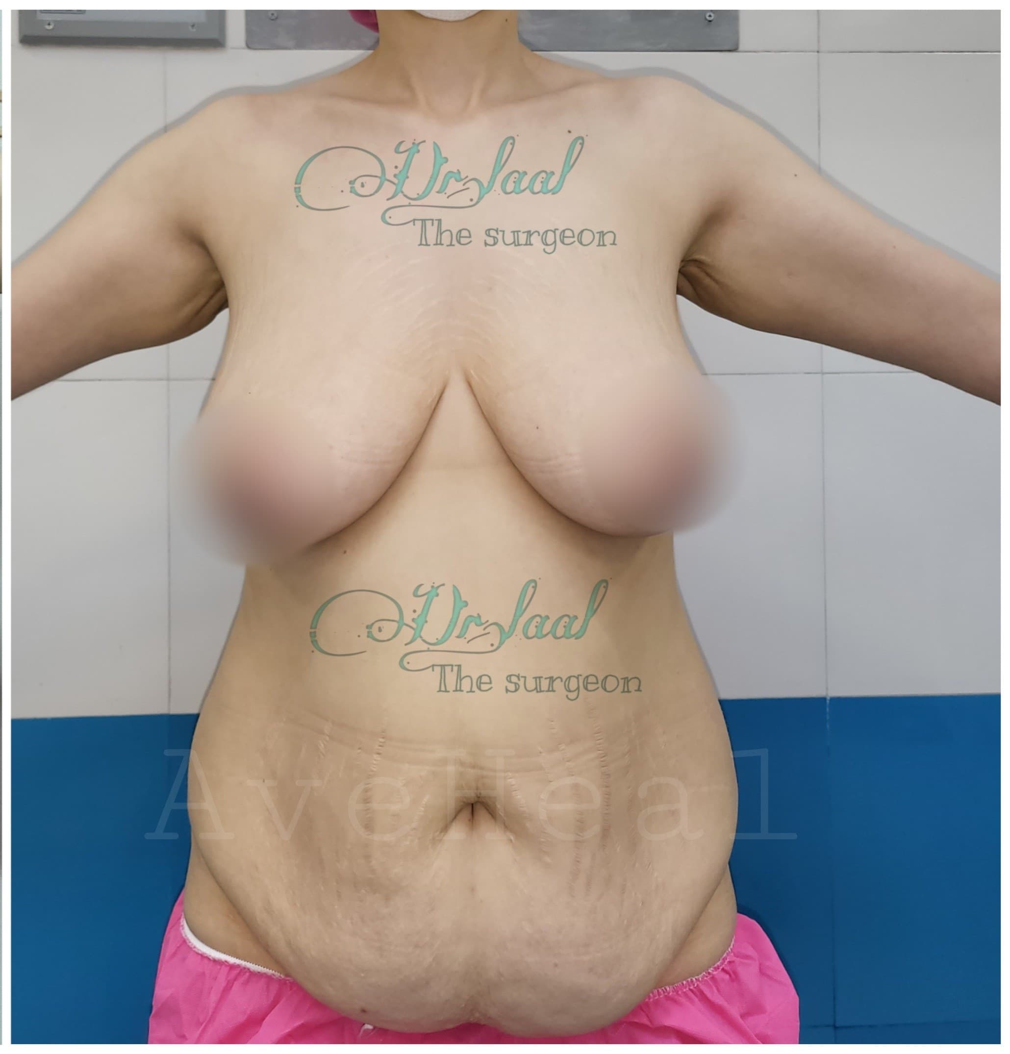 before-breast-lift-liposuction-abdominoplasty-dr-homeira-laal-khoshab